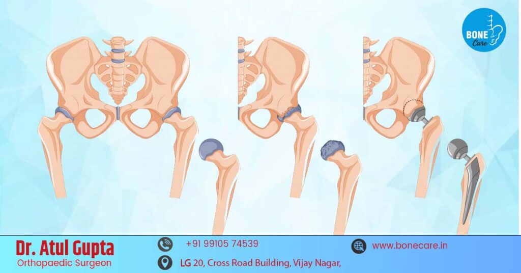 Femoral Fracture